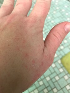 I have an allergic reaction whenever I exercise in the cold.